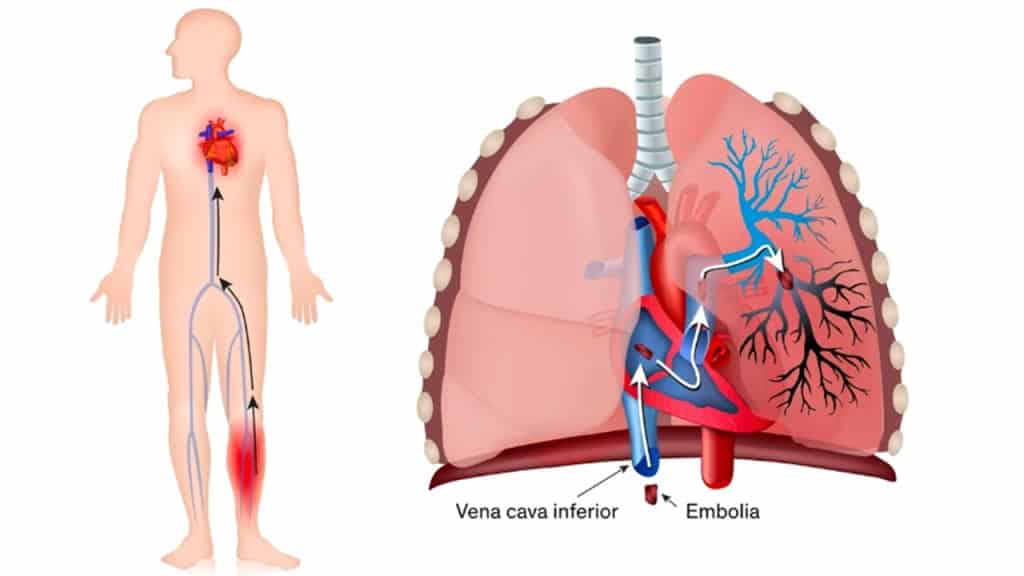 Pulmoner Emboli Nedir Kan Pihtilari Akcigeri Nasil Engeller1