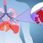 Pulmoner Emboli NedirKan Pıhtıları Akciğeri Nasıl Engeller