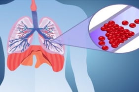 Pulmoner Emboli NedirKan Pıhtıları Akciğeri Nasıl Engeller