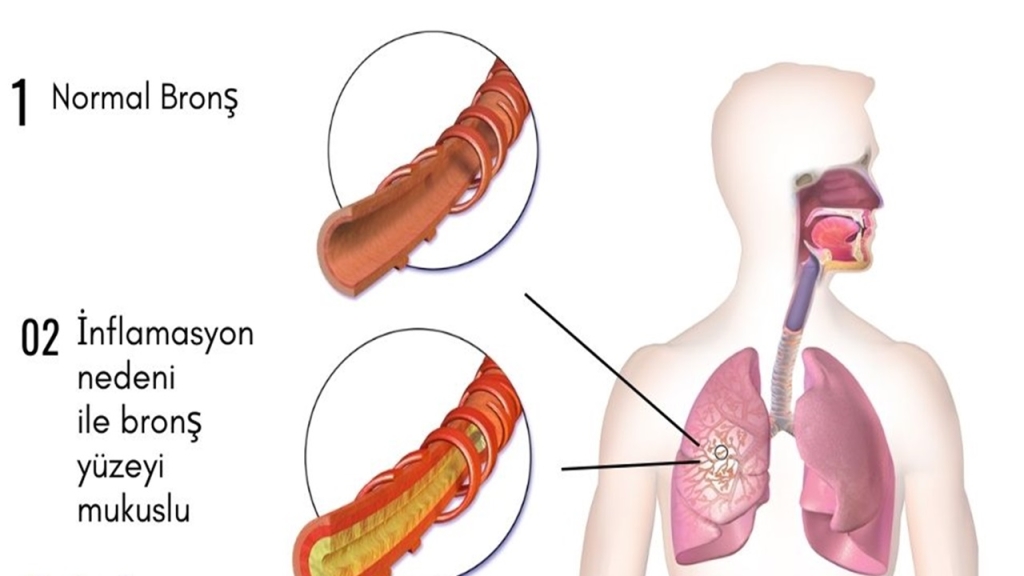Soguk Alginligindan Akciger Iltihabina Akut Bronsiti Taniyin1